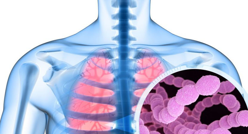 Al momento stai visualizzando Pneumococco