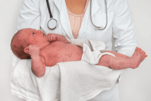 Read more about the article Measles in Italy in 2025: between the Milan outbreak and national challenge